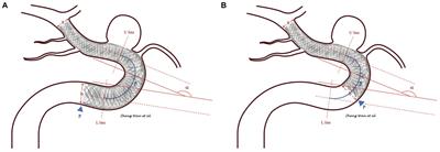 Flow diverter tail malapposition after implantation in the internal carotid artery for aneurysm treatment: a preliminary study